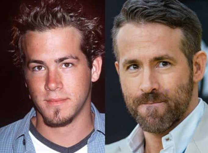 Ryan Reynolds Plastic Surgery