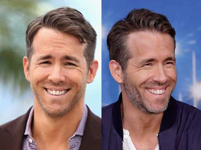 Ryan Reynolds Plastic Surgery