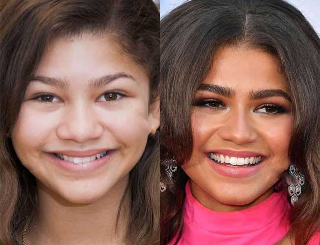 Zendaya Plastic Surgery