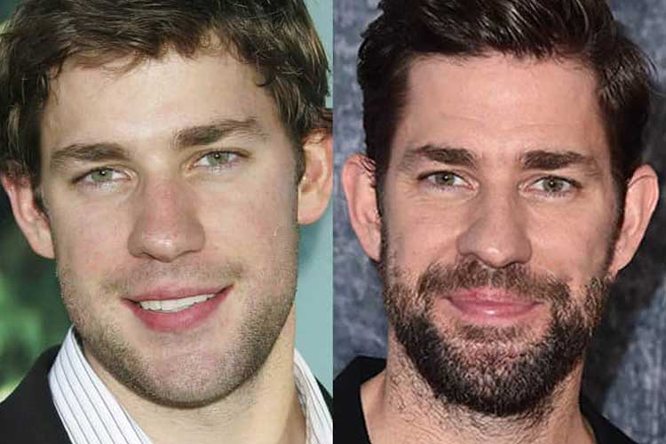 John Krasinski Plastic Surgery