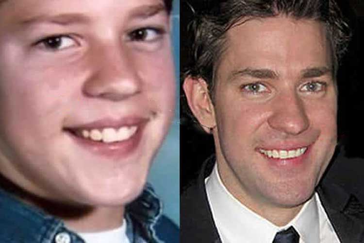 John Krasinski Plastic Surgery