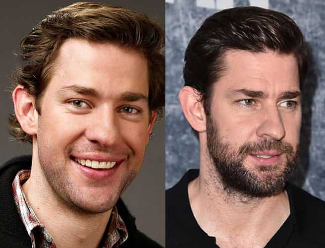 John Krasinski Plastic Surgery