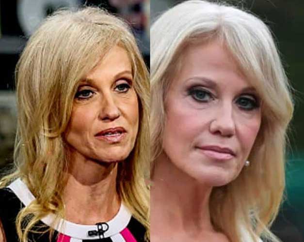 Kellyanne Conway Plastic Surgery