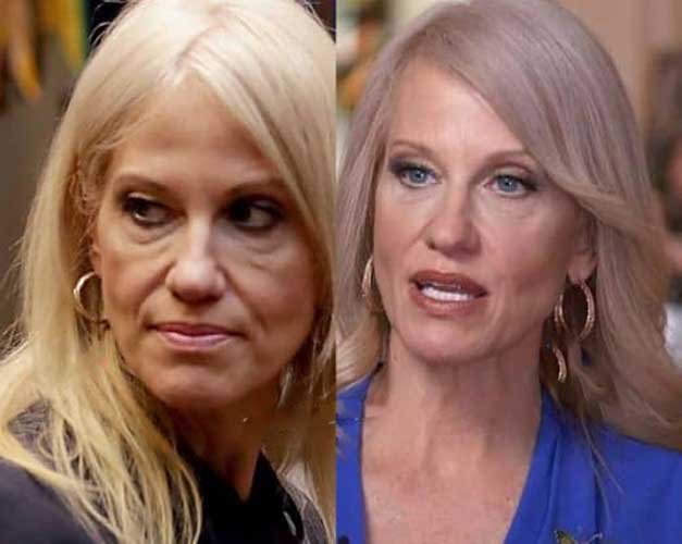 Kellyanne Conway Plastic Surgery