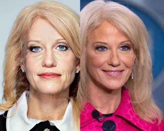 Kellyanne Conway Plastic Surgery