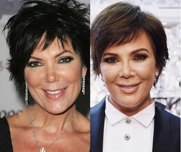 Kris Jenner Plastic Surgery