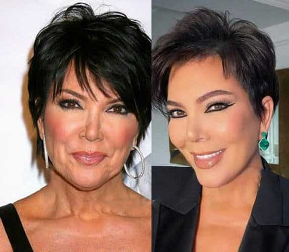 Kris Jenner Plastic Surgery