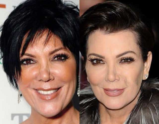 Kris Jenner Plastic Surgery