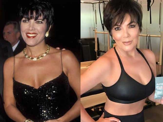 Kris Jenner Plastic Surgery