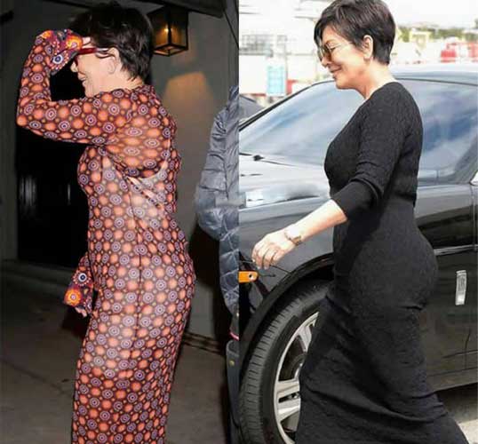 Kris Jenner Plastic Surgery