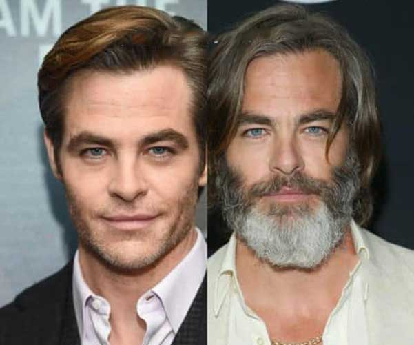 Chris Pine Plastic Surgery 