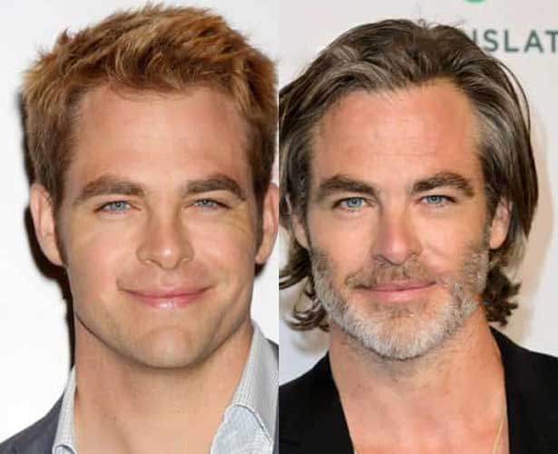 Chris Pine Plastic Surgery 