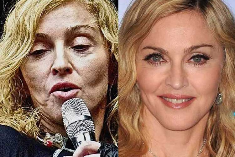 Madonna Plastic Surgery