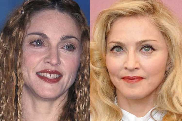 Madonna Plastic Surgery