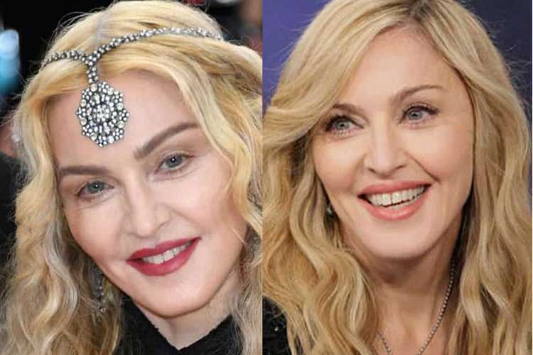 Madonna Plastic Surgery