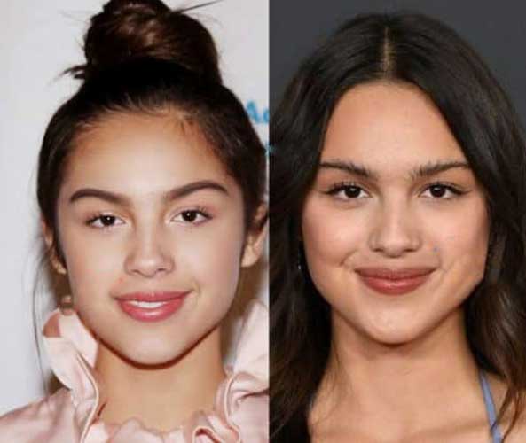 Olivia Rodrigo Plastic Surgery