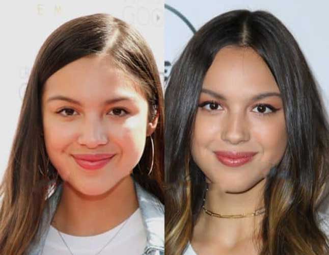 Olivia Rodrigo Plastic Surgery