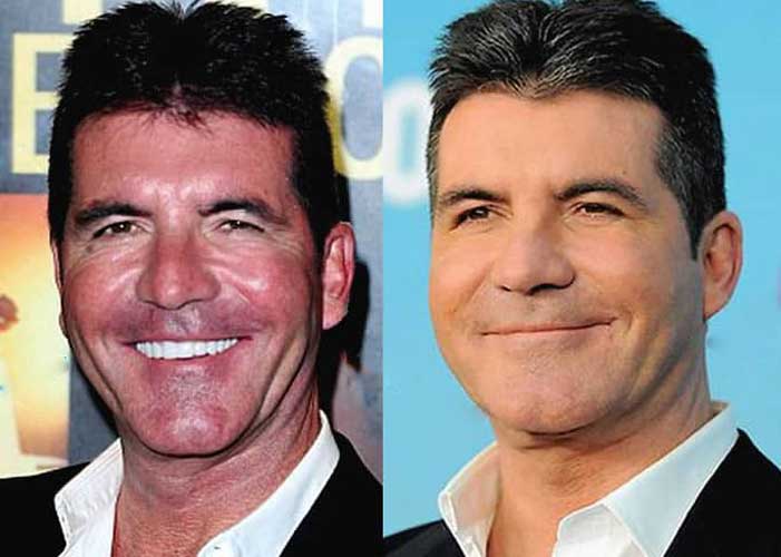 Simon Cowell Plastic Surgery