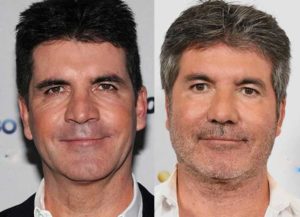 Simon Cowell Plastic Surgery: Botox, Facelift and Cheek Implants