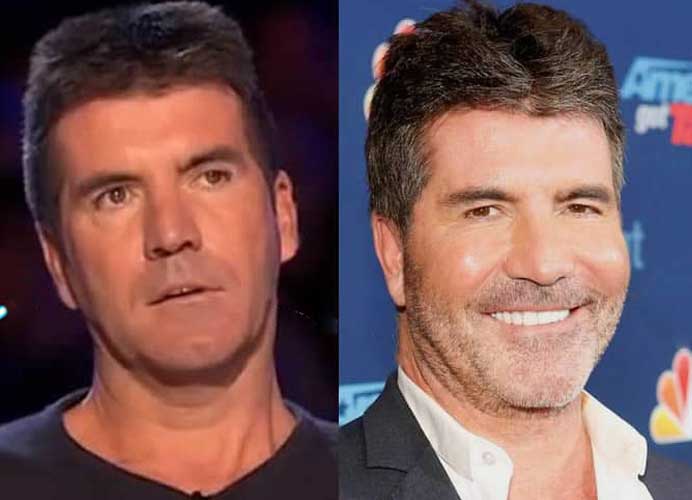 Simon Cowell Plastic Surgery