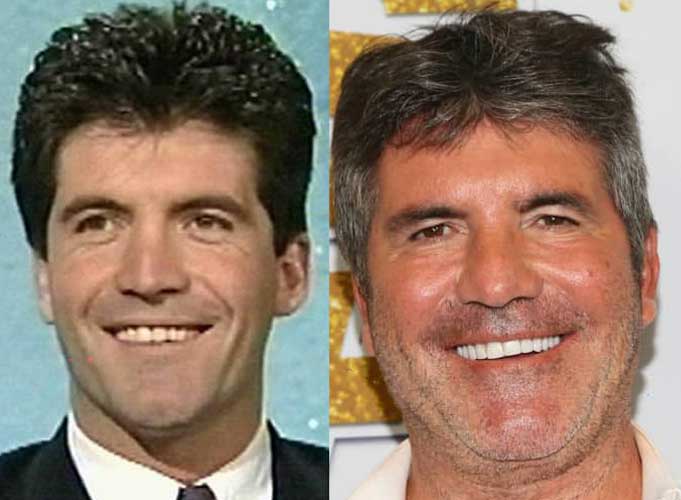 Simon Cowell Plastic Surgery