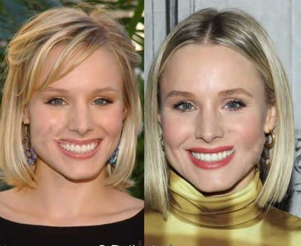 Kristen Bell Plastic Surgery Botox and Nose Job