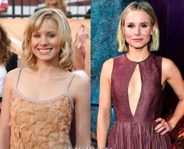 Kristen Bell Plastic Surgery Botox and Nose Job