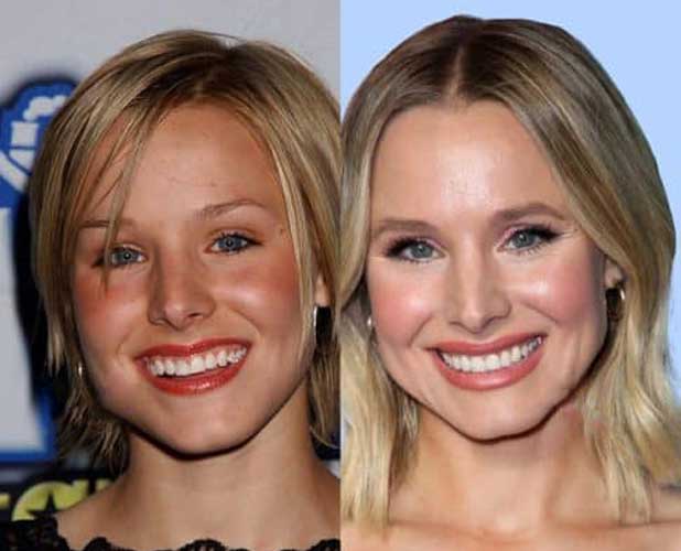 Kristen Bell Plastic Surgery Botox and Nose Job