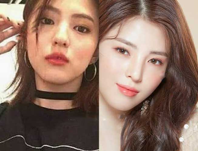 Han So Hee Plastic Surgery