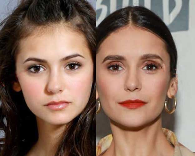 Nina Dobrev Plastic Surgery