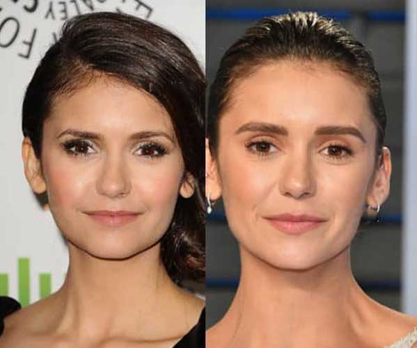 Nina Dobrev Plastic Surgery