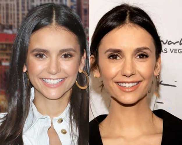 Nina Dobrev Plastic Surgery